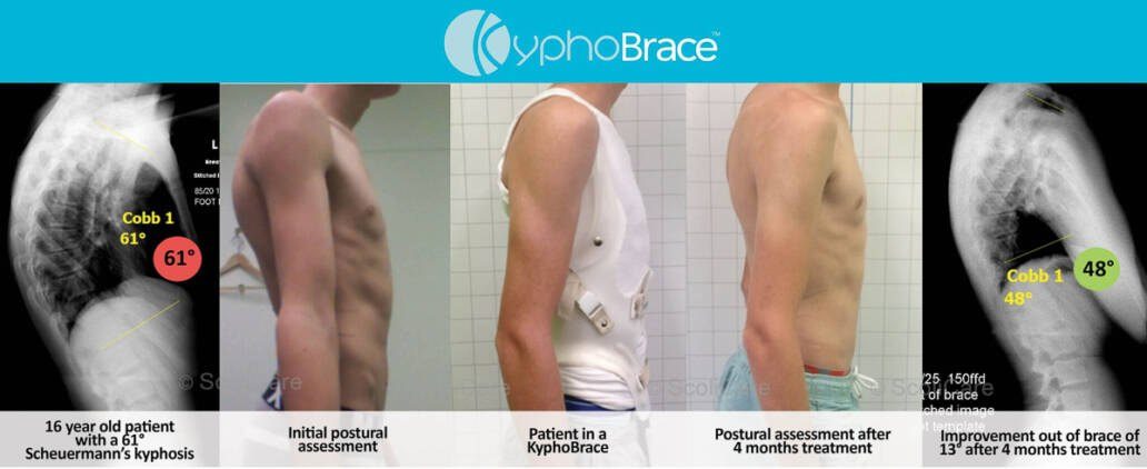 Before and after images from the clinic's kyphosis bracing care